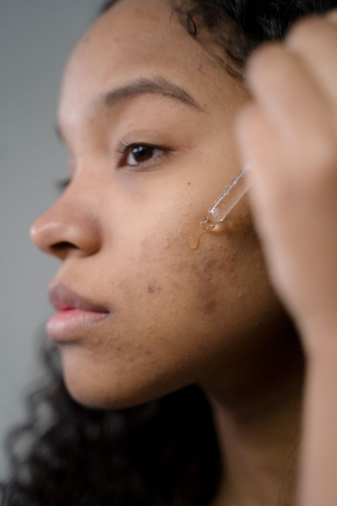 eczema